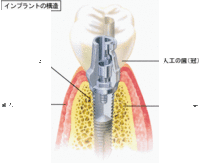 インプラント　オペ