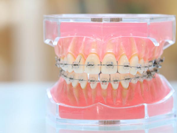 三重県鈴鹿市大木歯科医院のインプラント7つの特徴-矯正治療との併用で、機能面・審美面の改善が可能に