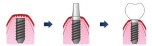 インプラント治療の流れ