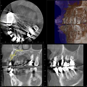 レントゲン（ステントパノラマ・CT）検査では、3次元的に口腔内の状態を確認します