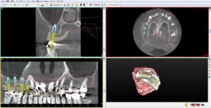 SIMPLANT®（シムプラント）－インプラント術前シミュレーション