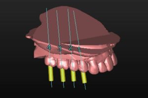 SIMPLANT®（シムプラント）－インプラント術前シミュレーション