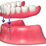痛くない・外れにくい総入れ歯「インプラントオーバーデンチャー」
