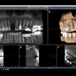 インプラント術前検査
