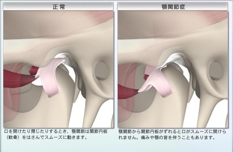 顎関節症治療