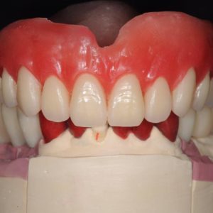 インプラント上部構造製作中のイメージ