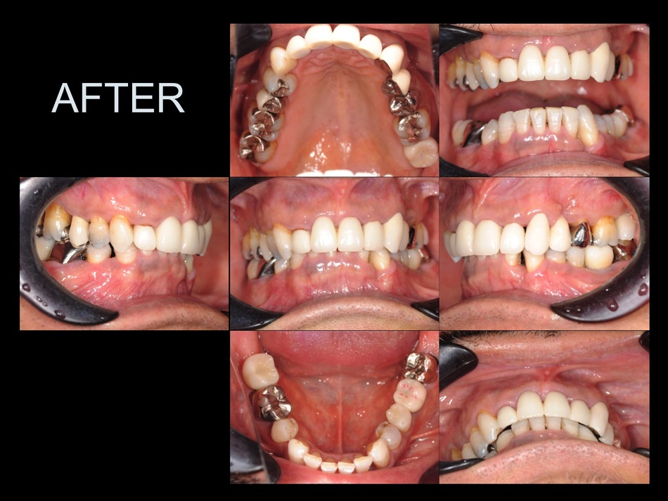 矯正治療とインプラント治療を用いて、機能面と審美面の改善