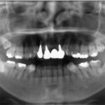 歯列不正のまま虫歯治療がなされていたために清掃不良となり虫歯になってしまった症例　〜矯正治療の応用〜のイメージ