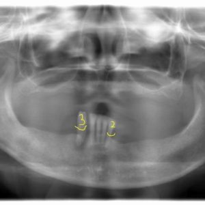 インプラント治療　CADCAM チタンフレーム　チタン用陶材を用いた上部構造のイメージ