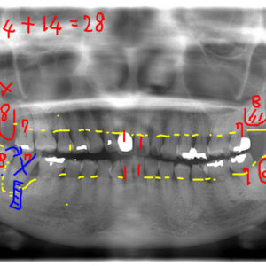 移植のイメージ