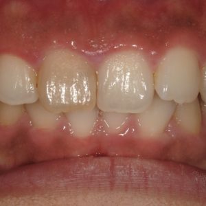 Walking Bleach（漂白）のイメージ