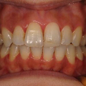 矯正のイメージ