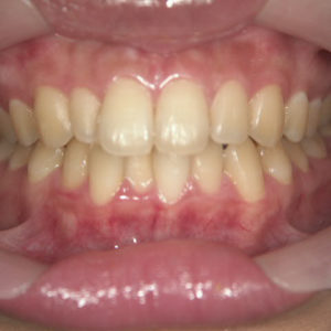 ホワイトニングのイメージ