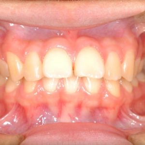 矯正治療〜上顎前突〜抜歯症例のイメージ