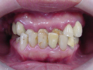 矯正治療後に差し歯を作り替えましたのイメージ