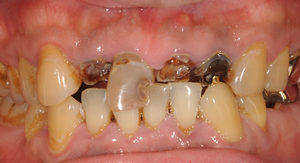 前歯が虫歯でボロボロです、、、。差し歯にしましょう。のイメージ