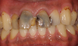 前歯のコンポジットレジン修復　CR充填のイメージ