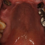 暫間インプラントを用いて1日で固定式の歯をセットした症例のイメージ