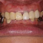 意外と目立つ奥歯の銀歯！前歯ジルコニアボンド、臼歯キャスタブルセラミックを用いた審美修復のイメージ