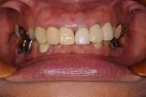 意外と目立つ奥歯の銀歯！前歯ジルコニアボンド、臼歯キャスタブルセラミックを用いた審美修復のイメージ