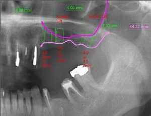 上顎ソケットリフトのイメージ