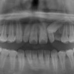 埋伏歯の開窓手術＆部分矯正のイメージ
