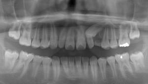 埋伏歯の開窓手術＆部分矯正のイメージ