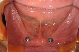 歯が１本もない方にお勧めのインプラントオーバーデンチャーのイメージ