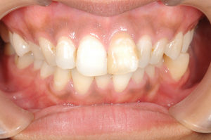 矯正抜歯症例のイメージ