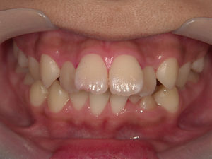 歯列矯正　中学〜高校生のイメージ