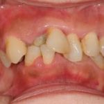 重度歯周炎に対して歯周病治療および矯正治療の後インプラントにて欠損部位を補綴のイメージ