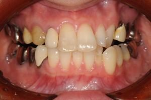 矯正後インプラントとe-Max（二ケイ酸リチウム）によるセラミック治療のイメージ