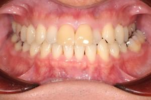 ラミネートベニアとセラミックインレーによる審美修復　e Maxのイメージ