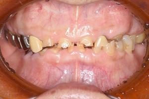 プロビジョナル　レストレーション　綺麗な仮歯を入れて機能性審美性の確認をします！のイメージ