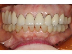 ホワイトニング＆審美補綴（オールセラミック〜ジルコニアボンド〜）部分矯正extrusionのイメージ