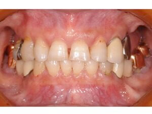 オールセラミッククラウン　ジルコニアボンドによる審美修復　〜４前歯の齲蝕および咬耗〜のイメージ