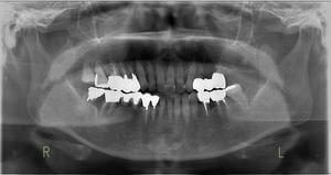 矯正とインプラントにより咬合再構成のイメージ