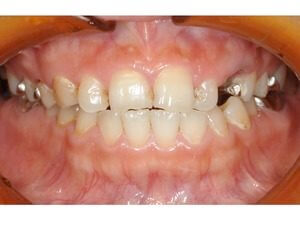 ラミネートベニア修復〜e Maxラミネートベニア〜のイメージ