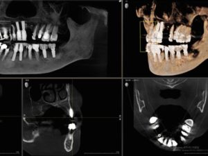 CTレントゲン ORTHOPHOS SL