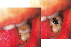 メタルフリーのイメージ