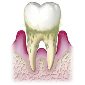 歯周病とは？