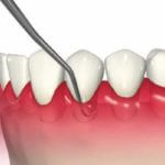 歯周病の治し方
