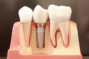 インプラントと差し歯の違いは？のイメージ