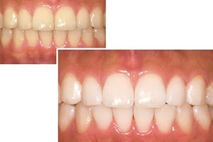 ホワイトニングのイメージ