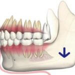 上の歯が伸び下の歯に当って骨の吸収が始まる