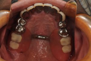 インプラントを用いて義歯（入れ歯）を固定のイメージ