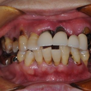 歯周病で総入れ歯になる患者様、インプラントを用いて固定式の歯にしましたのイメージ