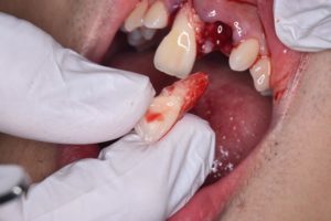 外傷で歯が抜けてしまった場合のイメージ