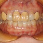 前歯のセラミック治療のイメージ