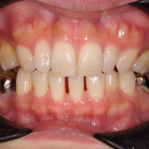 矯正治療〜骨移植〜インプラントのイメージ